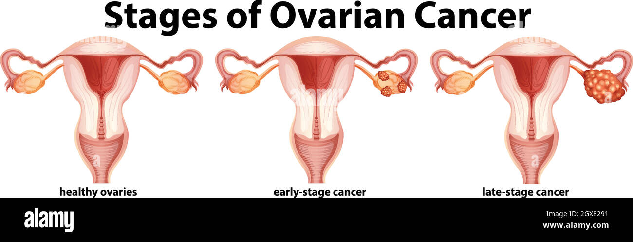 Schéma montrant les stades du cancer de l'ovaire Illustration de Vecteur