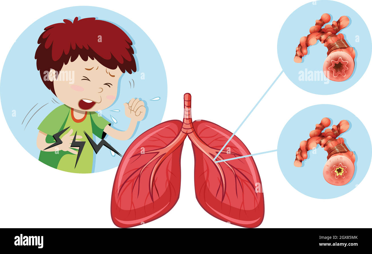 Un homme ayant une maladie pulmonaire obstructive chronique Illustration de Vecteur