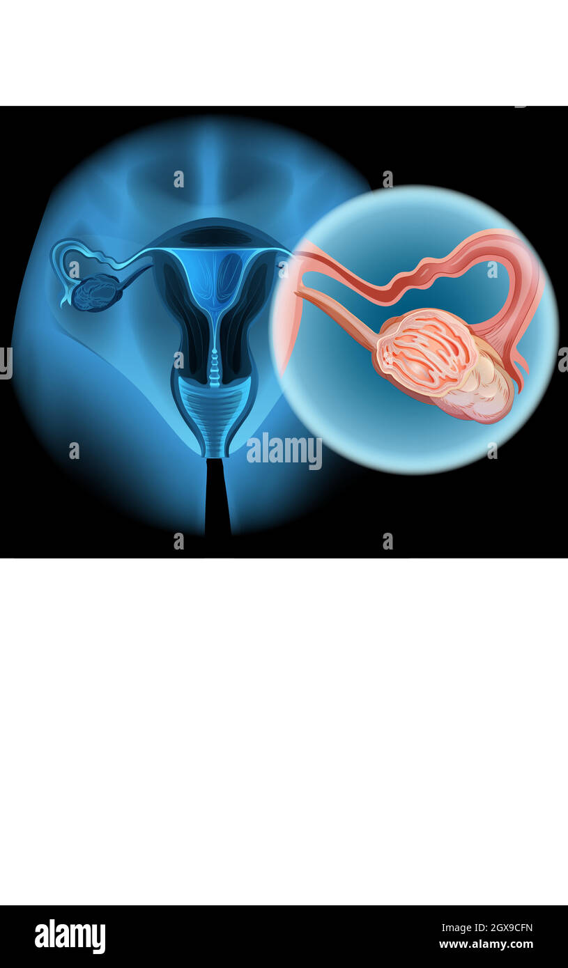 Diagramme du cancer de l'ovaire chez la femme Illustration de Vecteur
