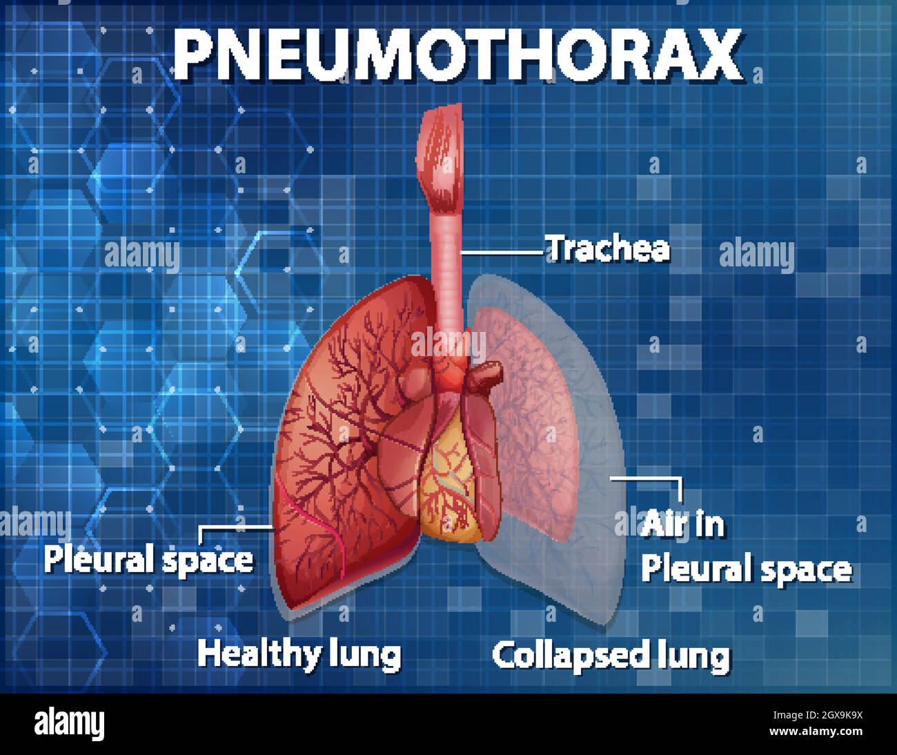 Illustration informative du pneumothorax Illustration de Vecteur