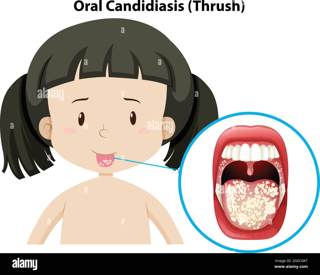 Candidose orale thursh sur la fille Illustration de Vecteur
