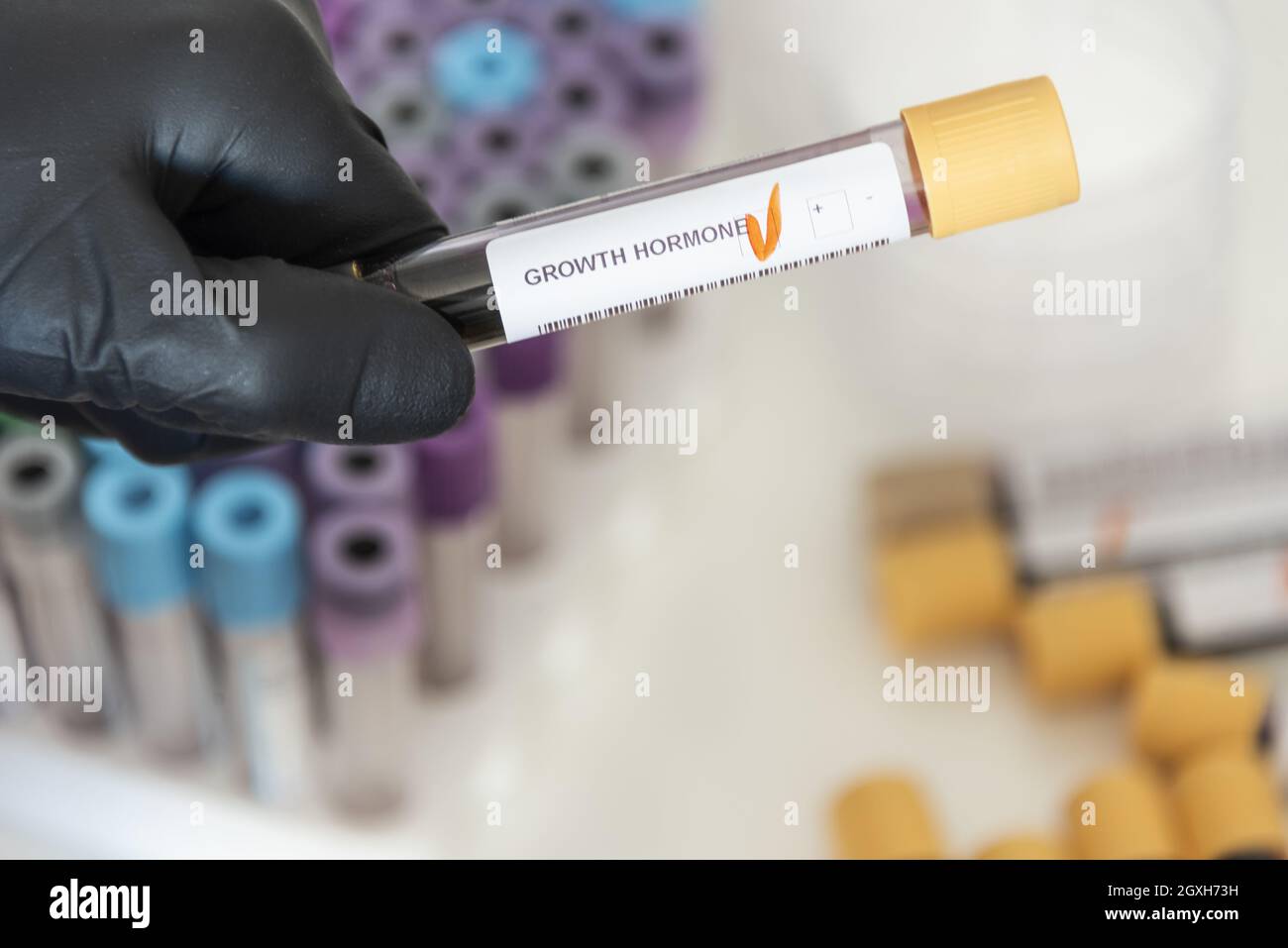 Gros plan de l'échantillon de sang positif de l'hormone de croissance. Banque D'Images