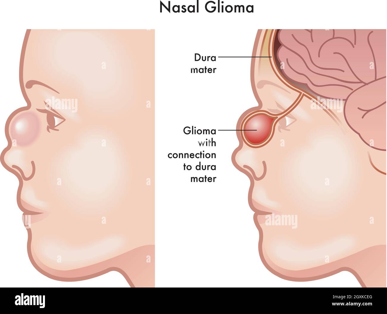 Illustration médicale des symptômes d'un gliome nasal sur un bébé, avec des annotations. Illustration de Vecteur