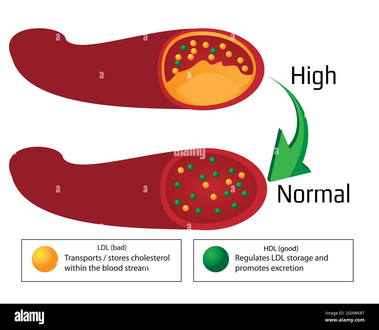 Transformer le niveau élevé de plaque athérosclérotique dans les vaisseaux  sanguins en niveau normal. Infographies de vecteur médical Photo Stock -  Alamy