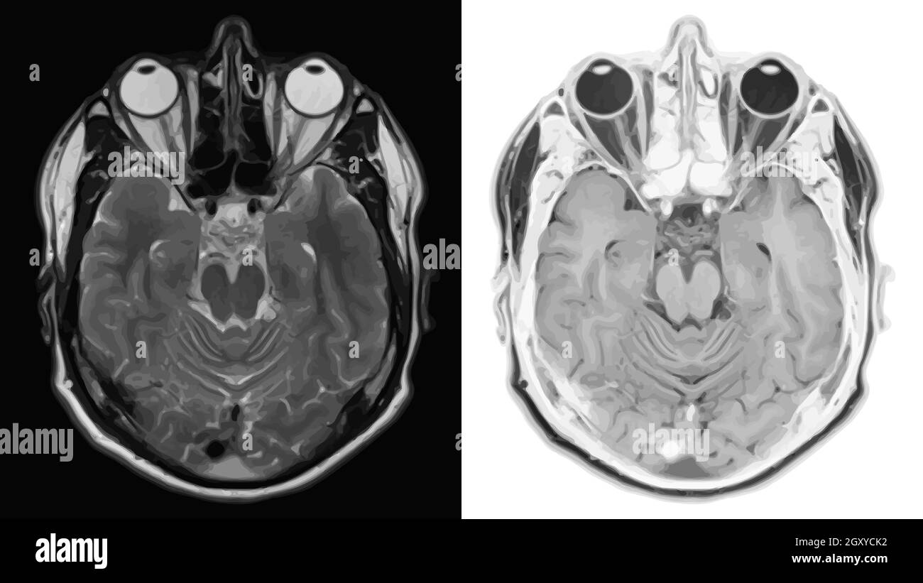 Coupe transversale réaliste du cerveau avec scanner, IRM imagerie par résonance magnétique de la couche de tête. Illustration vectorielle. Illustration de Vecteur