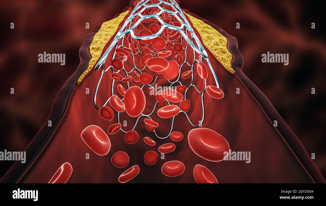 Illustration du rendu 3D de l'angioplastie.Stent déployé dans une artère ou un vaisseau sanguin malade obstrué par une plaque de cholestérol ou d'athérome avec une fl Banque D'Images