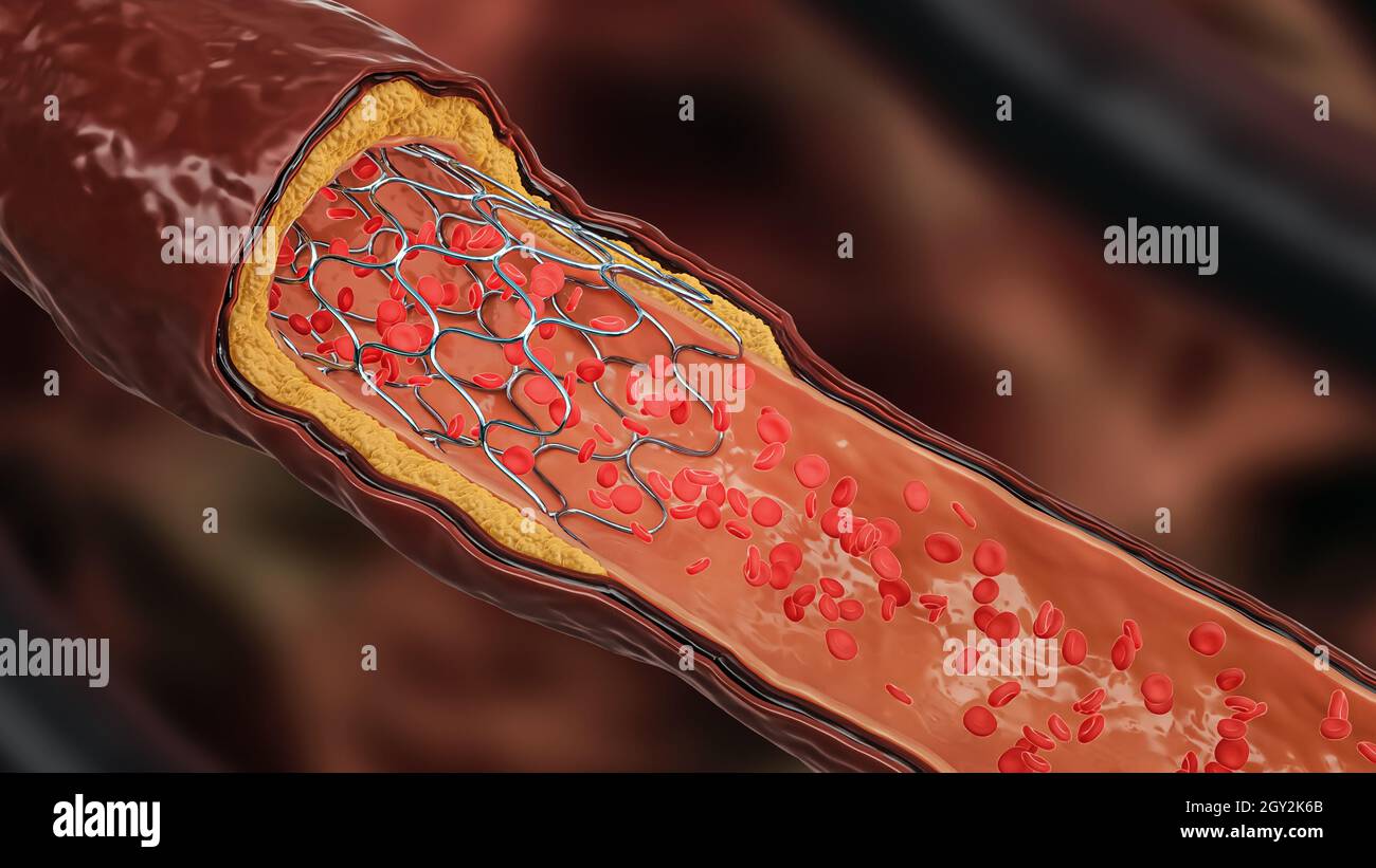 Illustration du rendu 3D de l'angioplastie.Stent déployé dans une artère ou un vaisseau sanguin malade obstrué par une plaque de cholestérol ou d'athérome avec une fl Banque D'Images