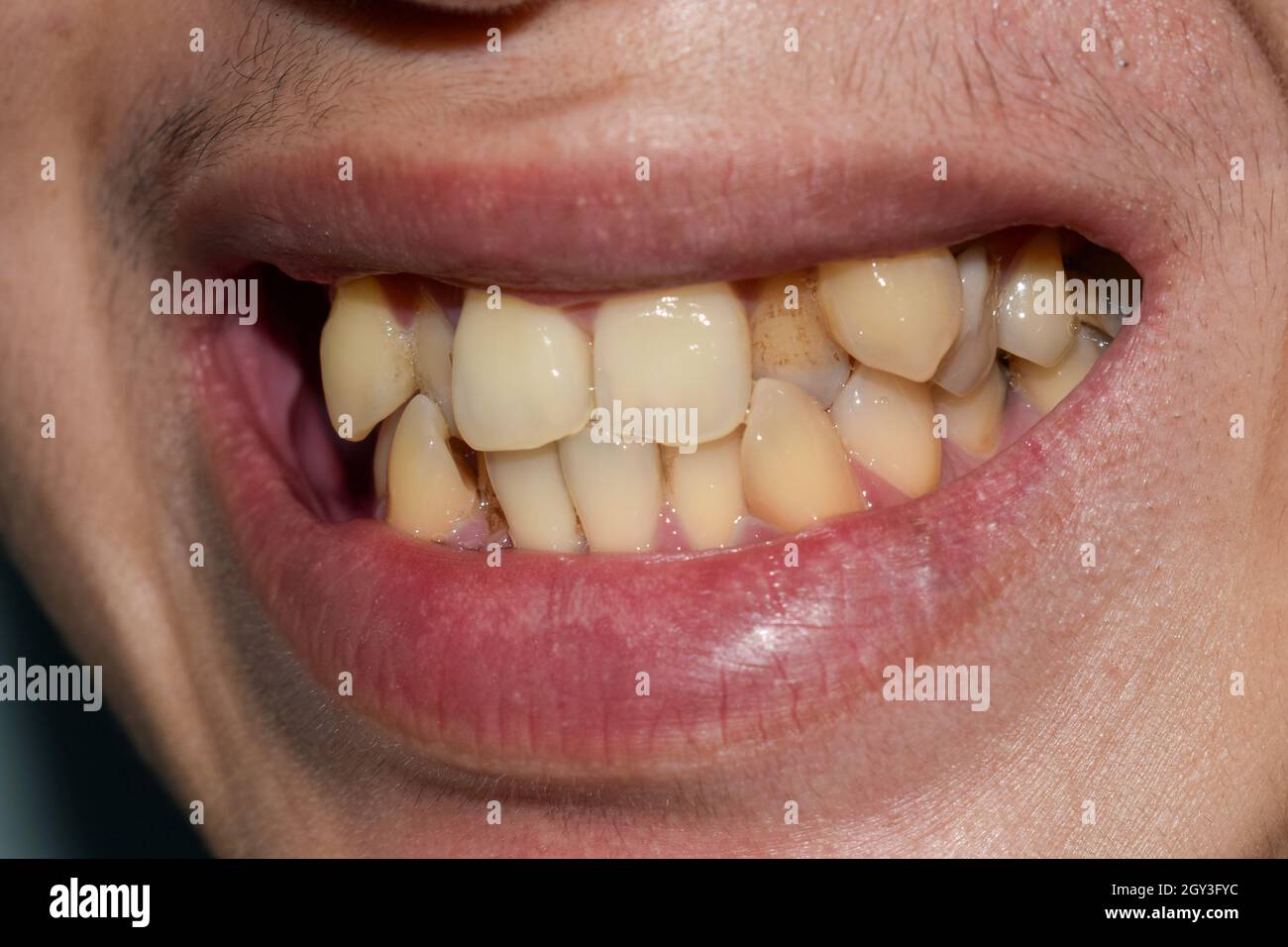 Dents empilées ou superposées avec une coloration jaune d'homme asiatique.Aussi appelé dents surpeuplées. Banque D'Images