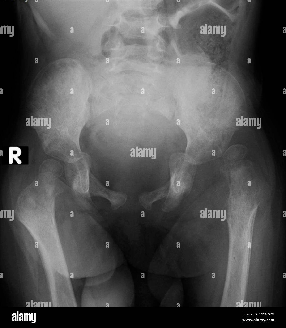 Developmental Dysplasia Of The Hip Banque D Image Et Photos Alamy