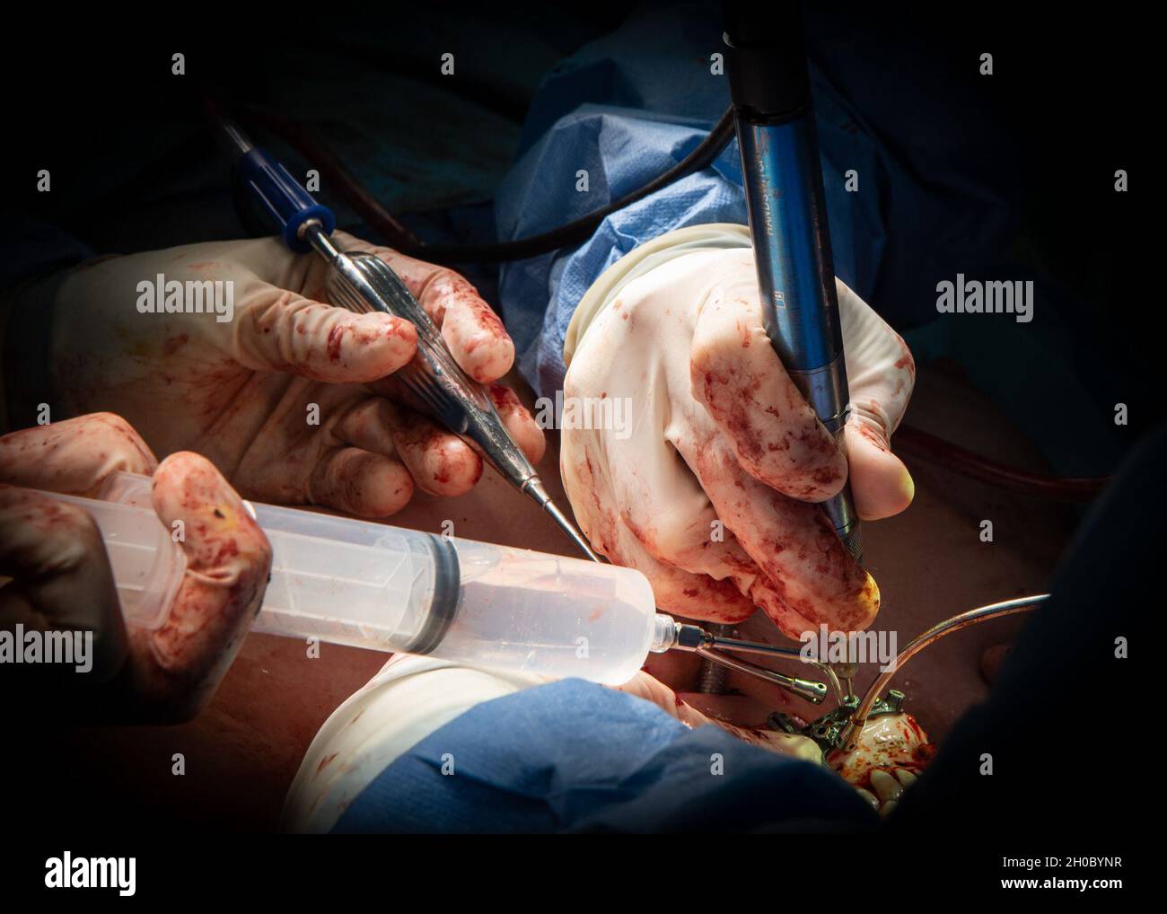 210120-N-DA693-1268 SAN DIEGO (JANV20, 2021) Une photo détaillée des mains des chirurgiens lors d'une reconstruction immédiate de la mâchoire avec des dents imprimées en 3D dans l'une des salles d'opération du Naval Medical Center de San Diego (NMCSD) le 20 janvier.L’intervention a été réalisée par des équipes des services de chirurgie buccale et maxillofaciale, de chirurgie plastique et d’otolaryngologie de l’hôpital.La chirurgie comprenait non seulement l’élimination du cancer, mais aussi la reconstruction d’une mâchoire à l’aide d’une section du péroné du patient, le plus petit des deux os de la jambe inférieure.La pandémie de COVID-19 a changé la façon dont de nombreuses facettes des soins de santé sont conduites Banque D'Images