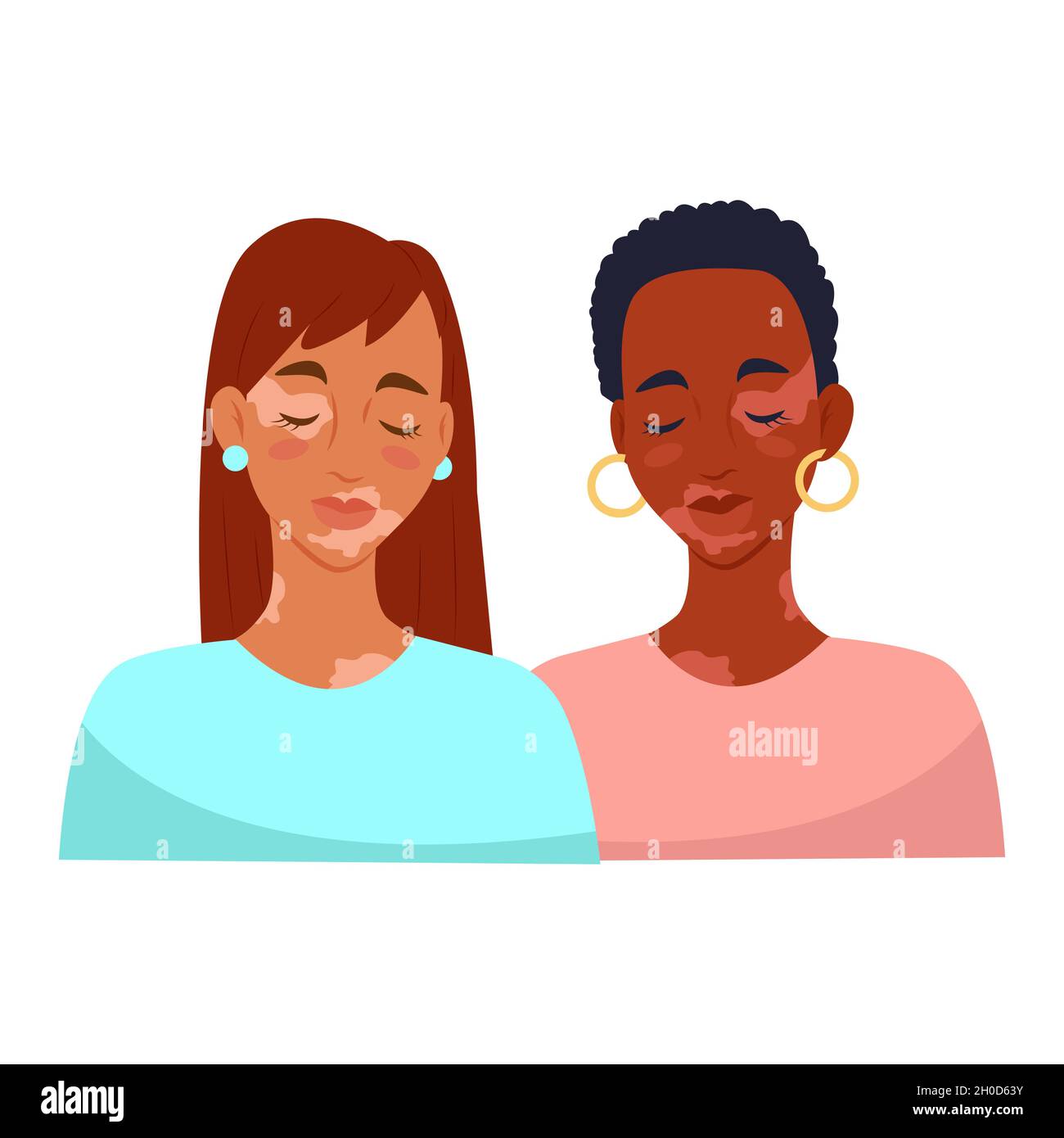 Deux femmes avec vitiligo.Maladie de peau de vitiligo.Illustration vectorielle Illustration de Vecteur