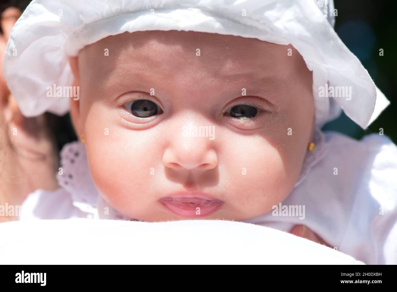 Inflammation Des Paupieres Banque D Image Et Photos Alamy