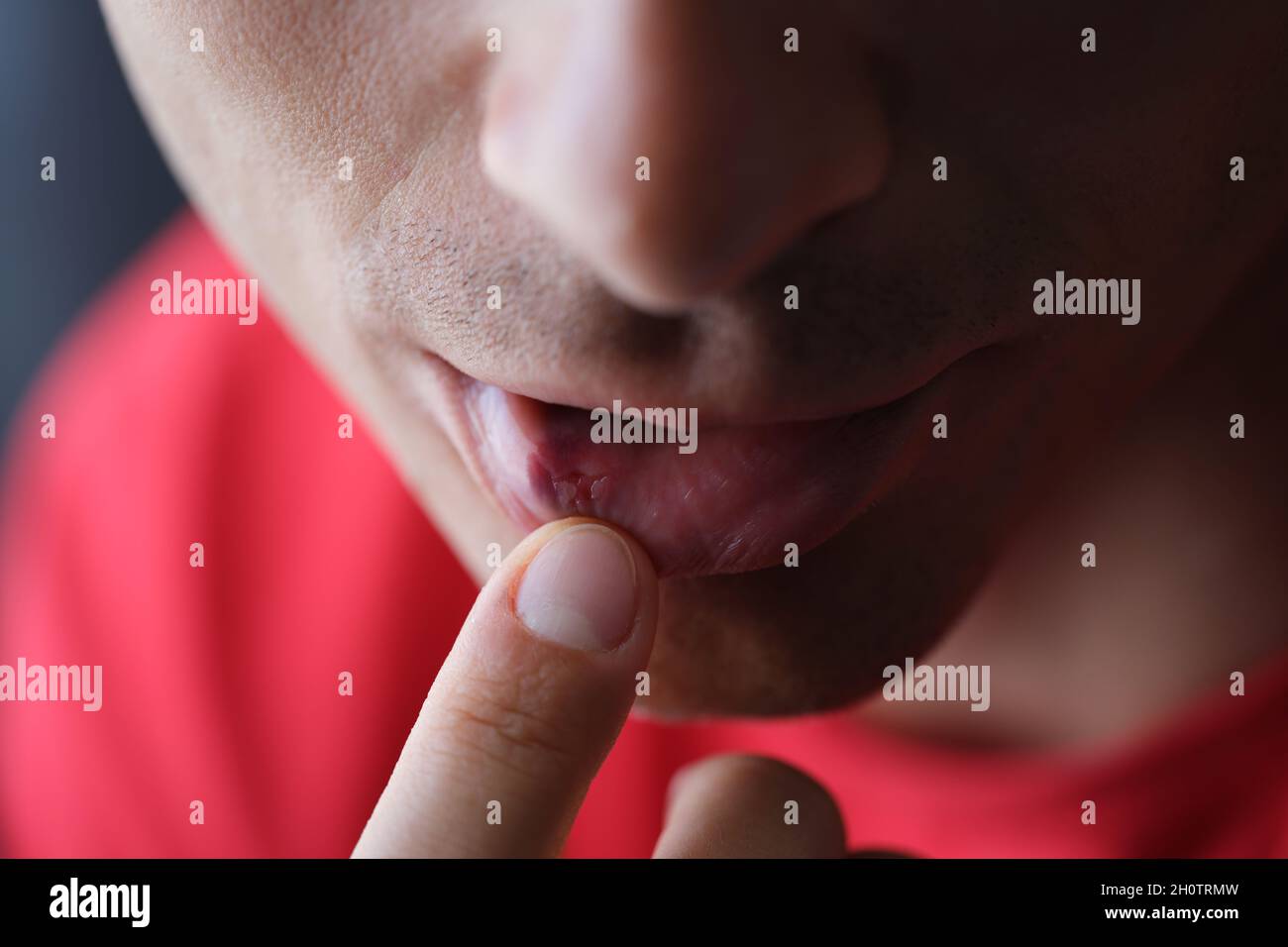 Sur l'herpès labial mâle de l'intérieur de gros plan Banque D'Images Sur l'herpès labial mâle de l'intérieur de gros plan Banque D'Images