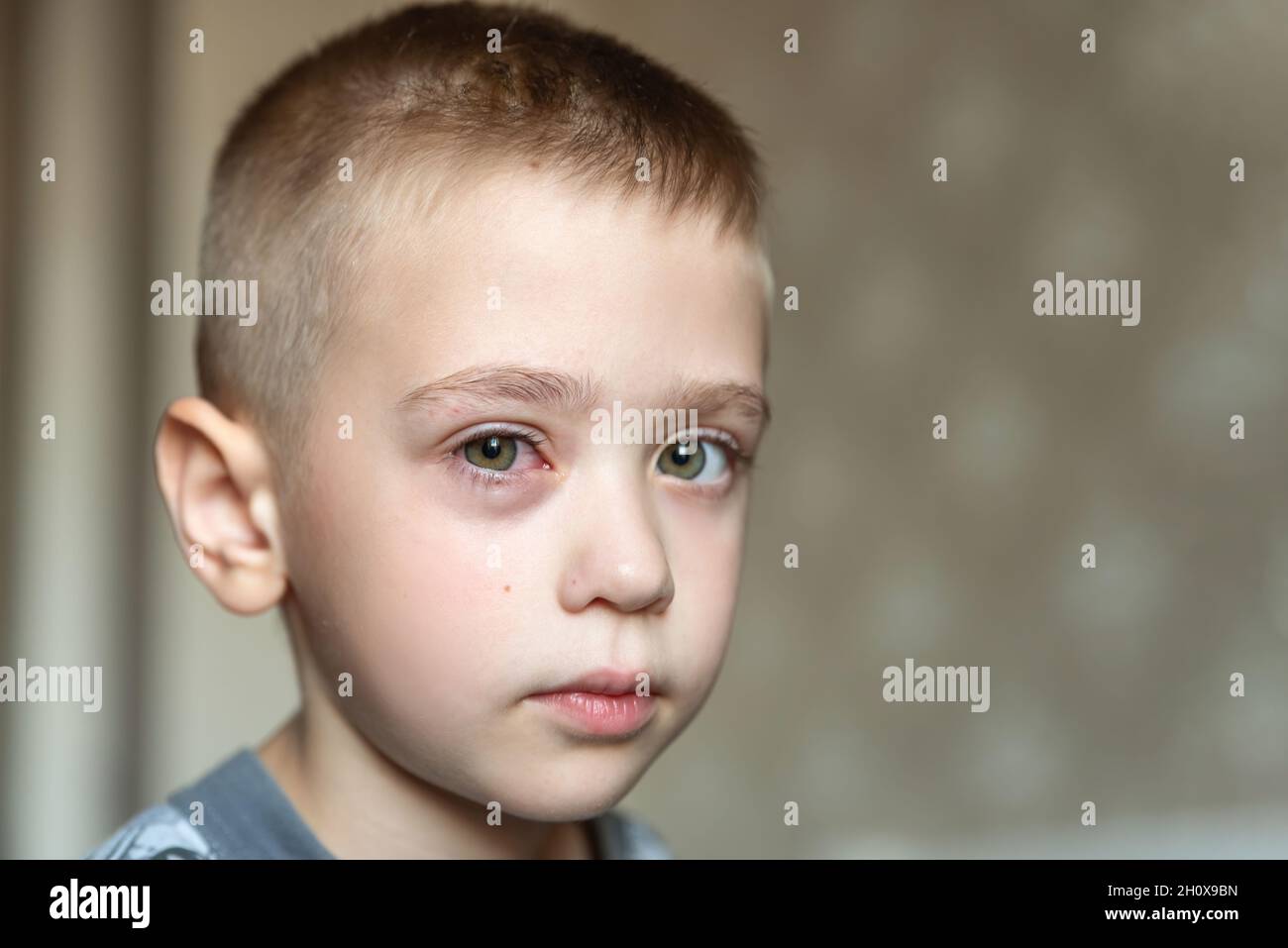 Allergie aux yeux rouges enflée chez le garçon.Portrait d'un ...