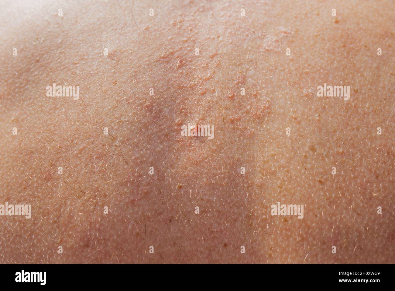 Séborrhée sur la peau du dos - traitement des conditions de la peau dans une station balnéaire - peau sèche et inflammation Banque D'Images