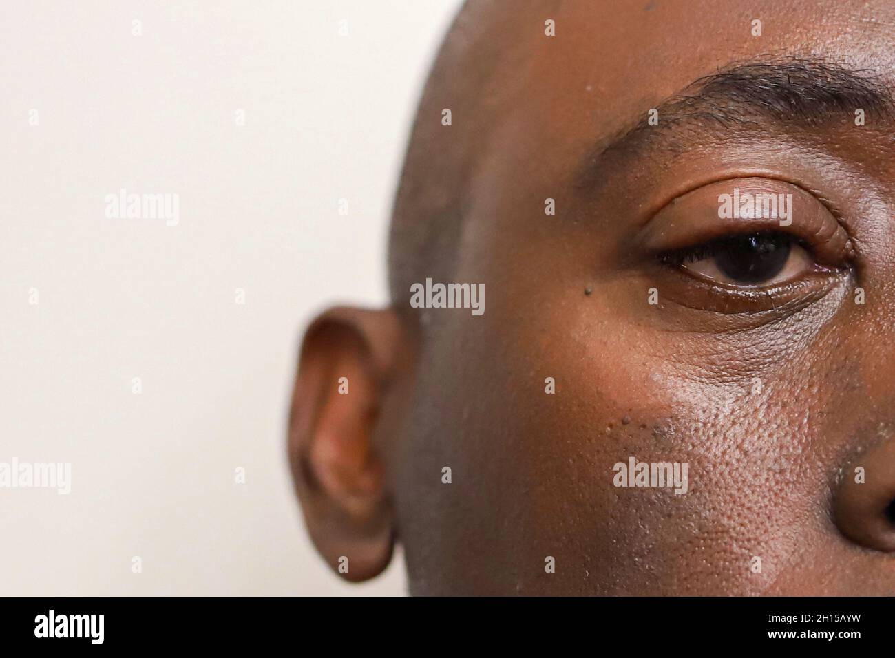 Une Image Rapprochee D Un Homme Afro Americain Noir Avec Une Paupiere Gonflee Sur Un Fond Blanc Photo Stock Alamy