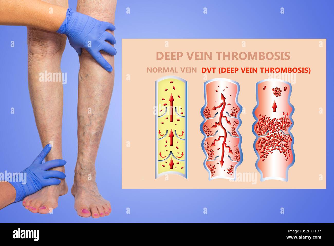 Thrombose veineuse profonde ou des caillots de sang. Embolie gazeuse. Structure de la normale et les varices veines femelle Banque D'Images