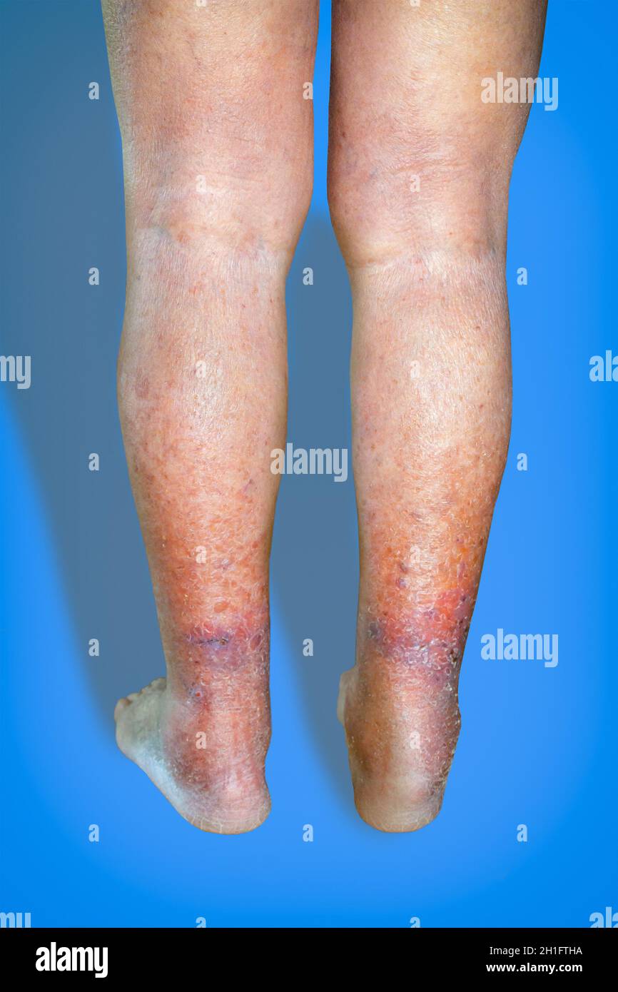 Close-up of de varices sur senior male de la jambe. Concept de la ...