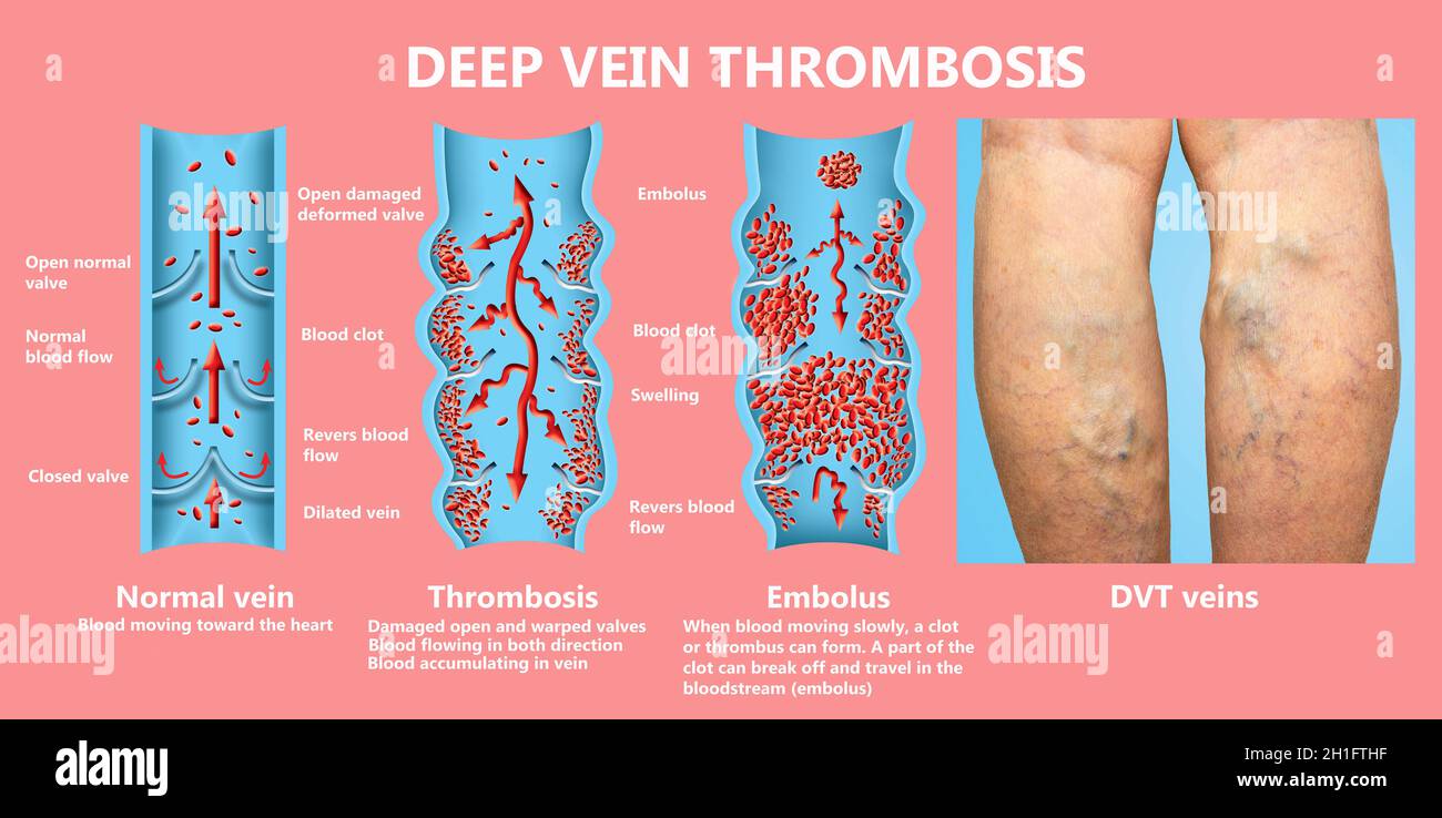 Thrombose veineuse profonde ou des caillots de sang. Embolie gazeuse. Structure de la normale et les varices veines femelle Banque D'Images