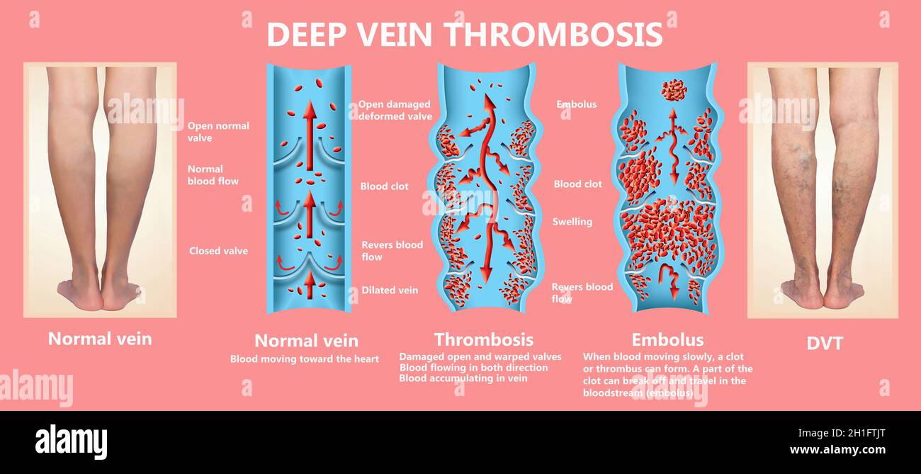 Thrombose veineuse profonde ou des caillots de sang. Embolie gazeuse. Structure de la normale et les varices veines femelle Banque D'Images