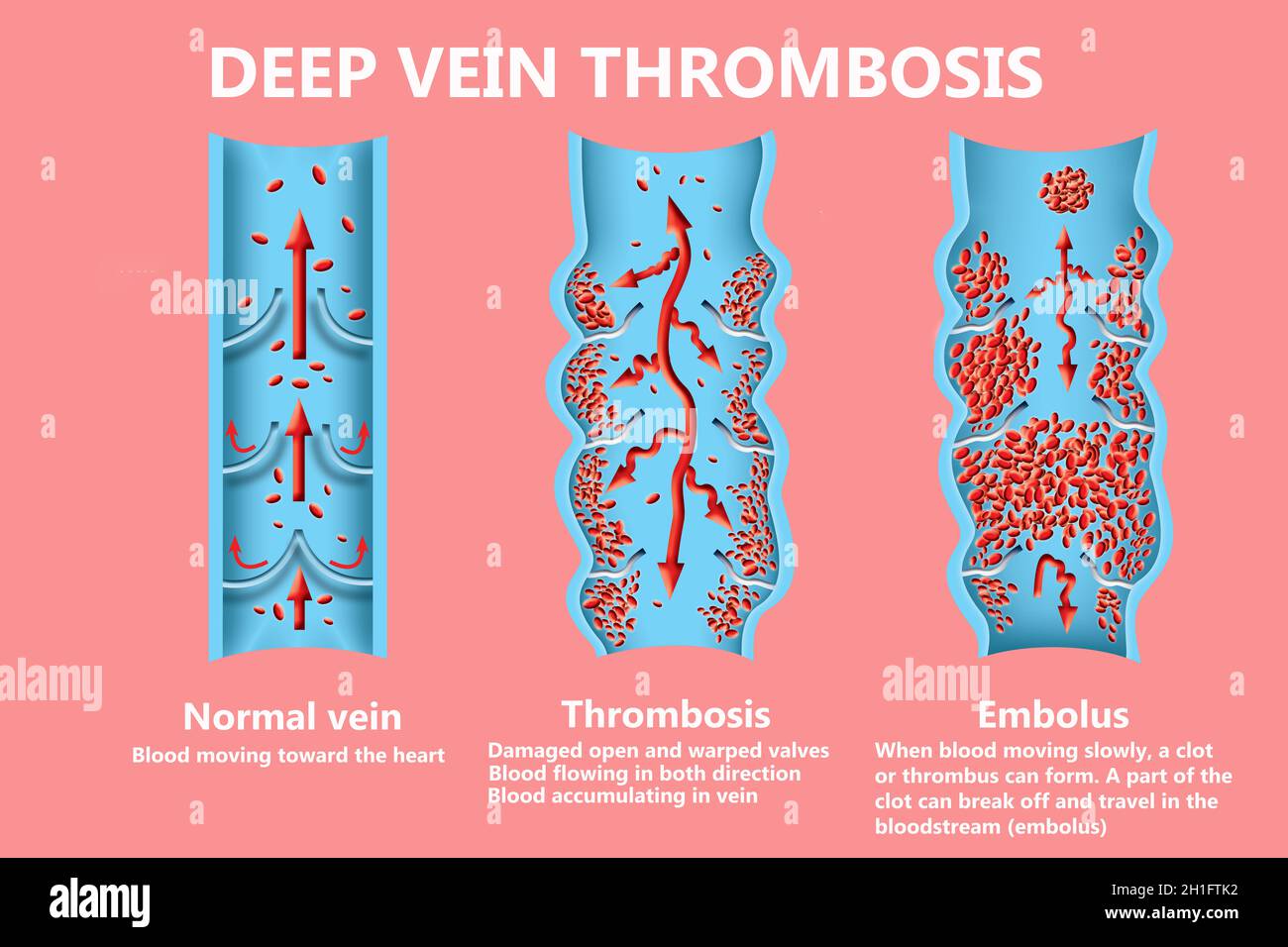 La thrombose. De la normale de la circulation sanguine vers la formation de caillots sanguins et clot, qui voyage dans le sang. L'embolie. Illustration pour la biologie, le medi Banque D'Images
