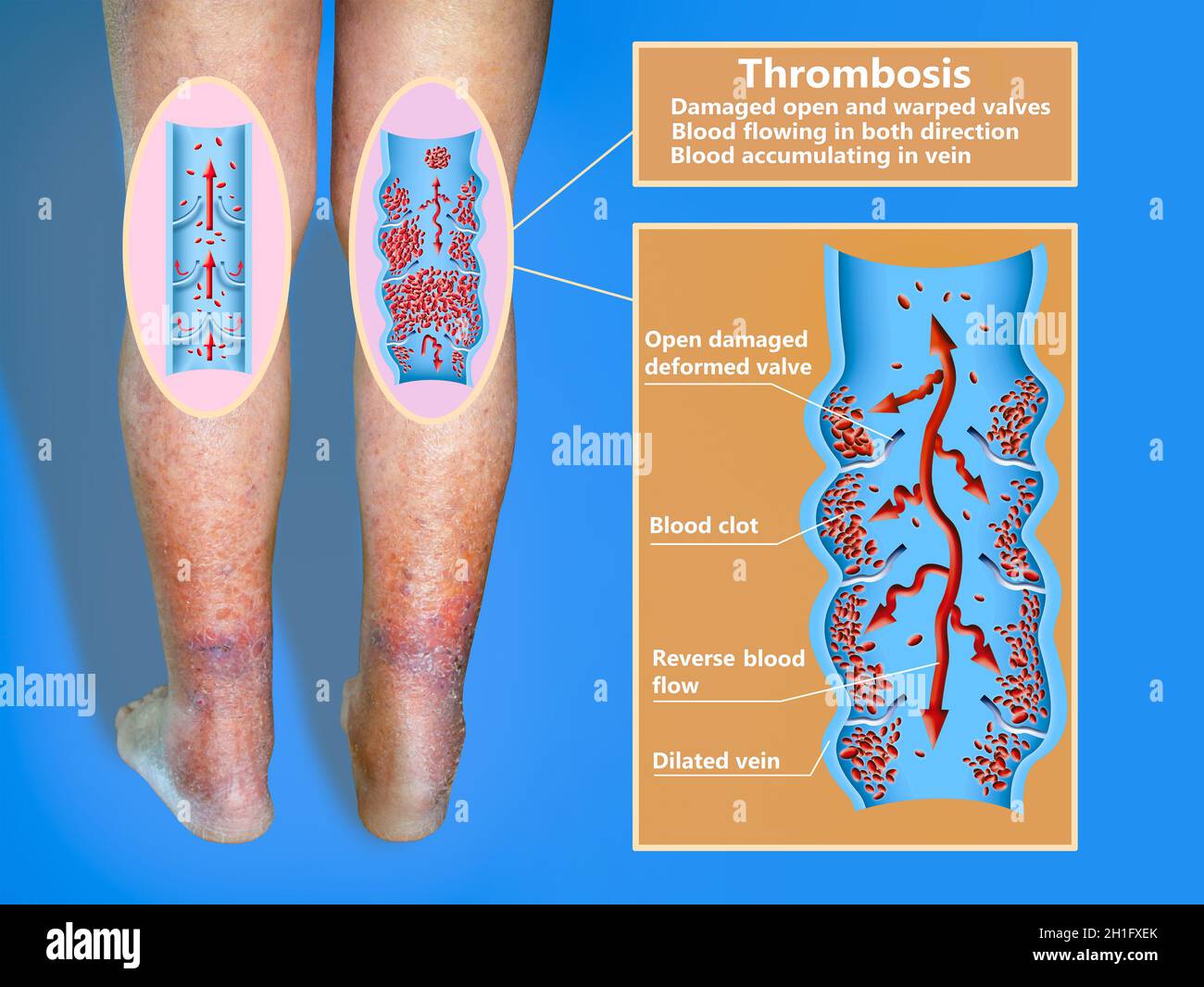 Thrombose Veineuse Profonde Ou Des Caillots De Sang Embolie Gazeuse