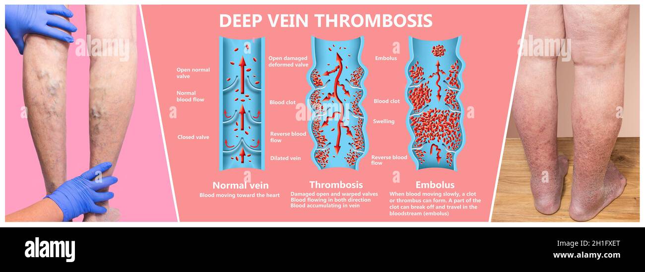 Thrombose Veineuse Profonde Ou Des Caillots De Sang Embolie Gazeuse