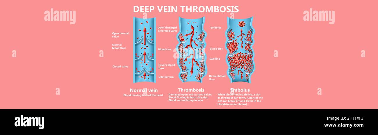 Thrombose veineuse profonde ou des caillots de sang. Embolie gazeuse. Structure de la normale et les varices veines femelle Banque D'Images