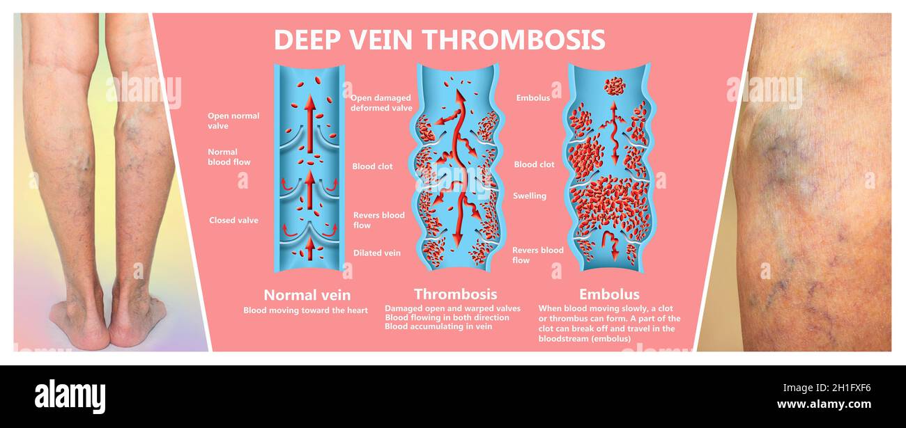 Thrombose veineuse profonde ou des caillots de sang. Embolie gazeuse. Structure de la normale et les varices veines femelle Banque D'Images
