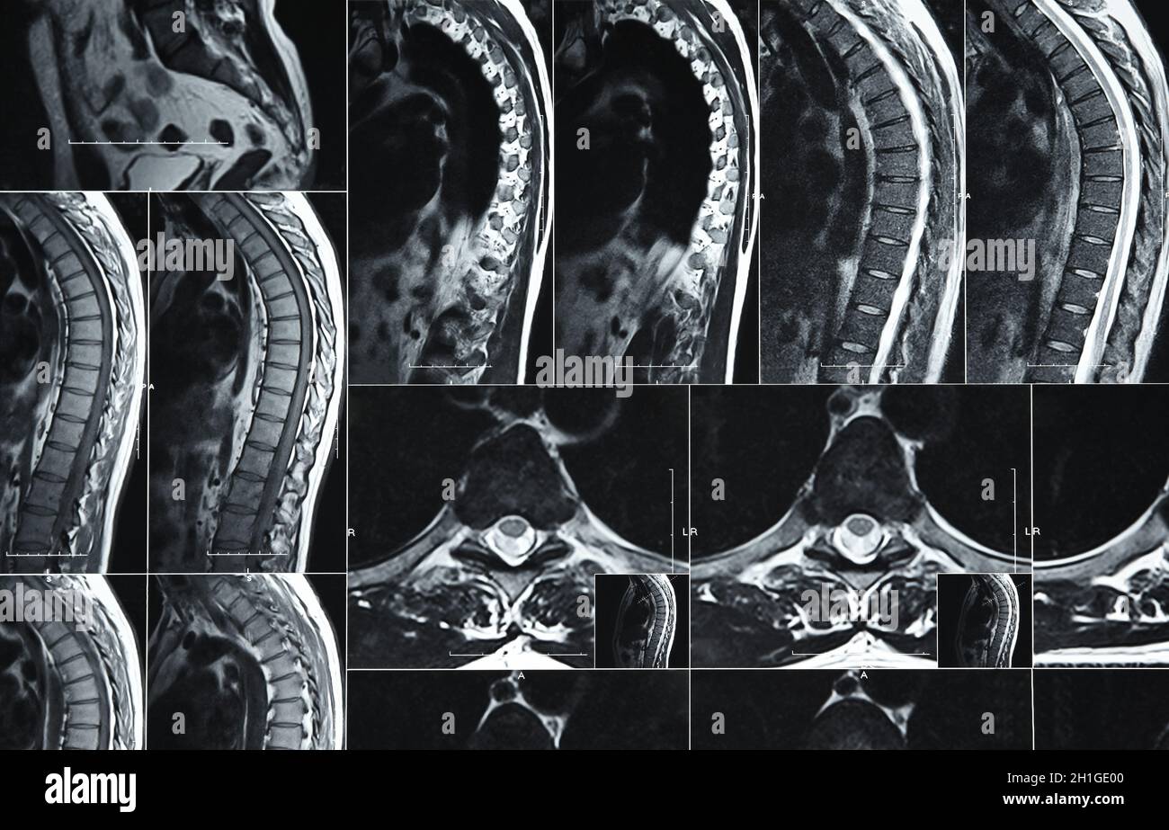 Imagerie par résonance magnétique en gros plan ou tomographie informatisée du rachis lombaire humain Banque D'Images