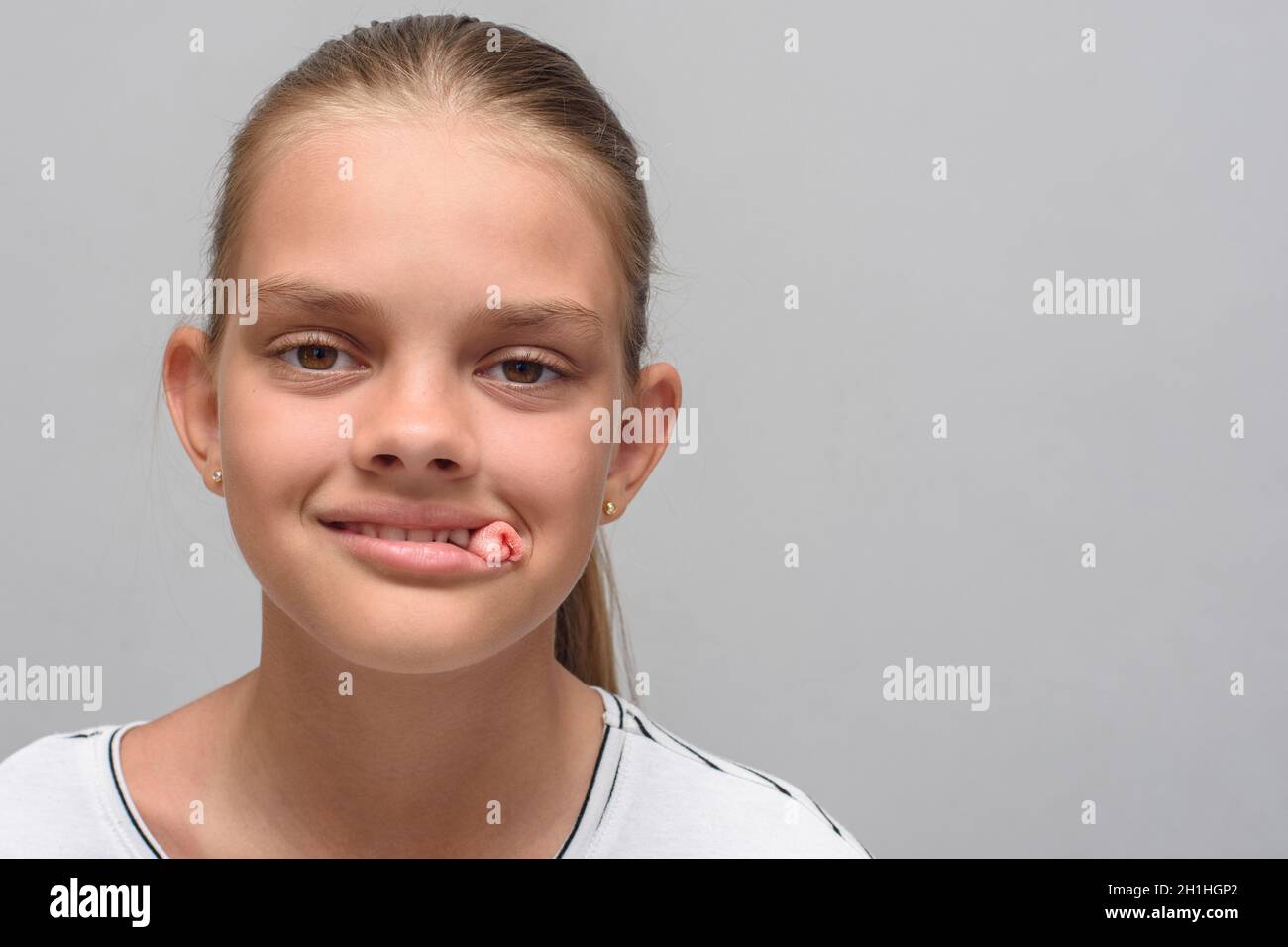 Portrait d'une fille de dix ans avec un tampon qui colle de sa bouche après  l'extraction de la dent Photo Stock - Alamy