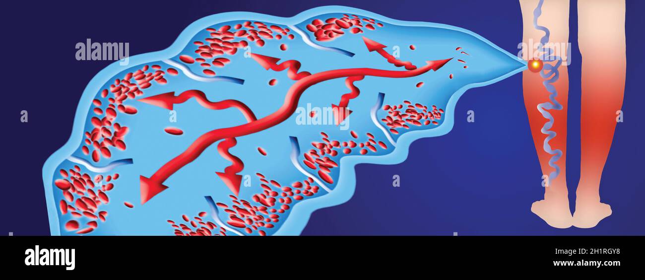 Varices sur les jambes des femmes.La structure de la veine - icône illustration du vecteur.DVT Banque D'Images