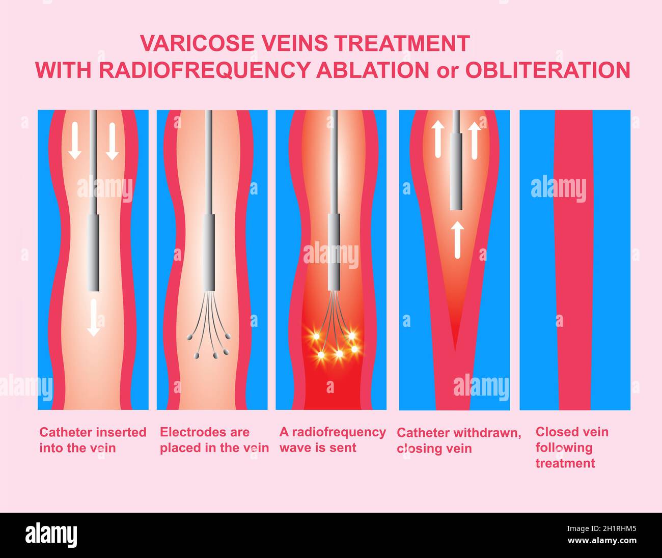 Varices.Traitement par ablation par radiofréquence ou par oblitération des jambes.Illustration