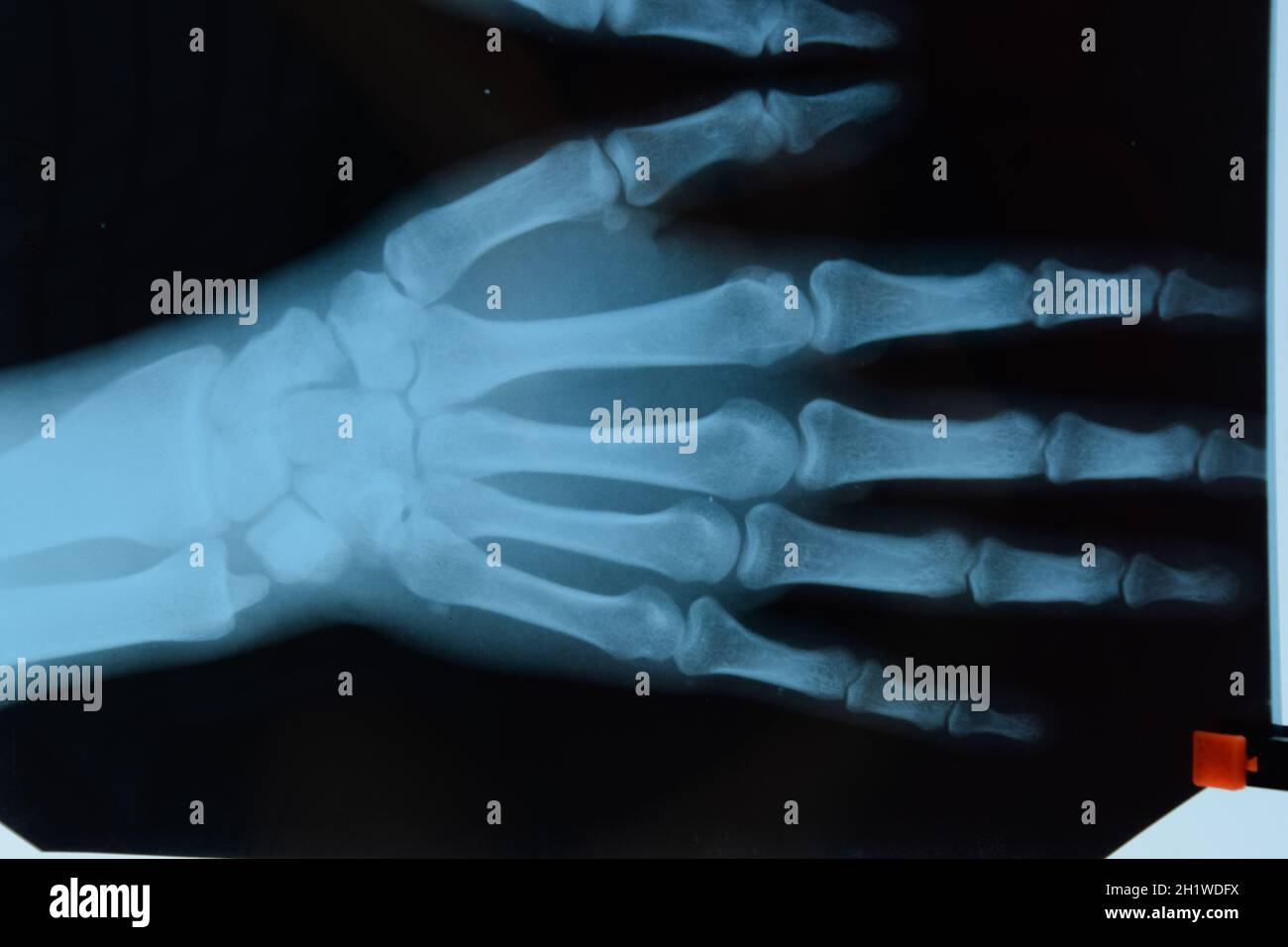 X-ray de la mains, une photo de l'os de la main sur le x-ray. Banque D'Images