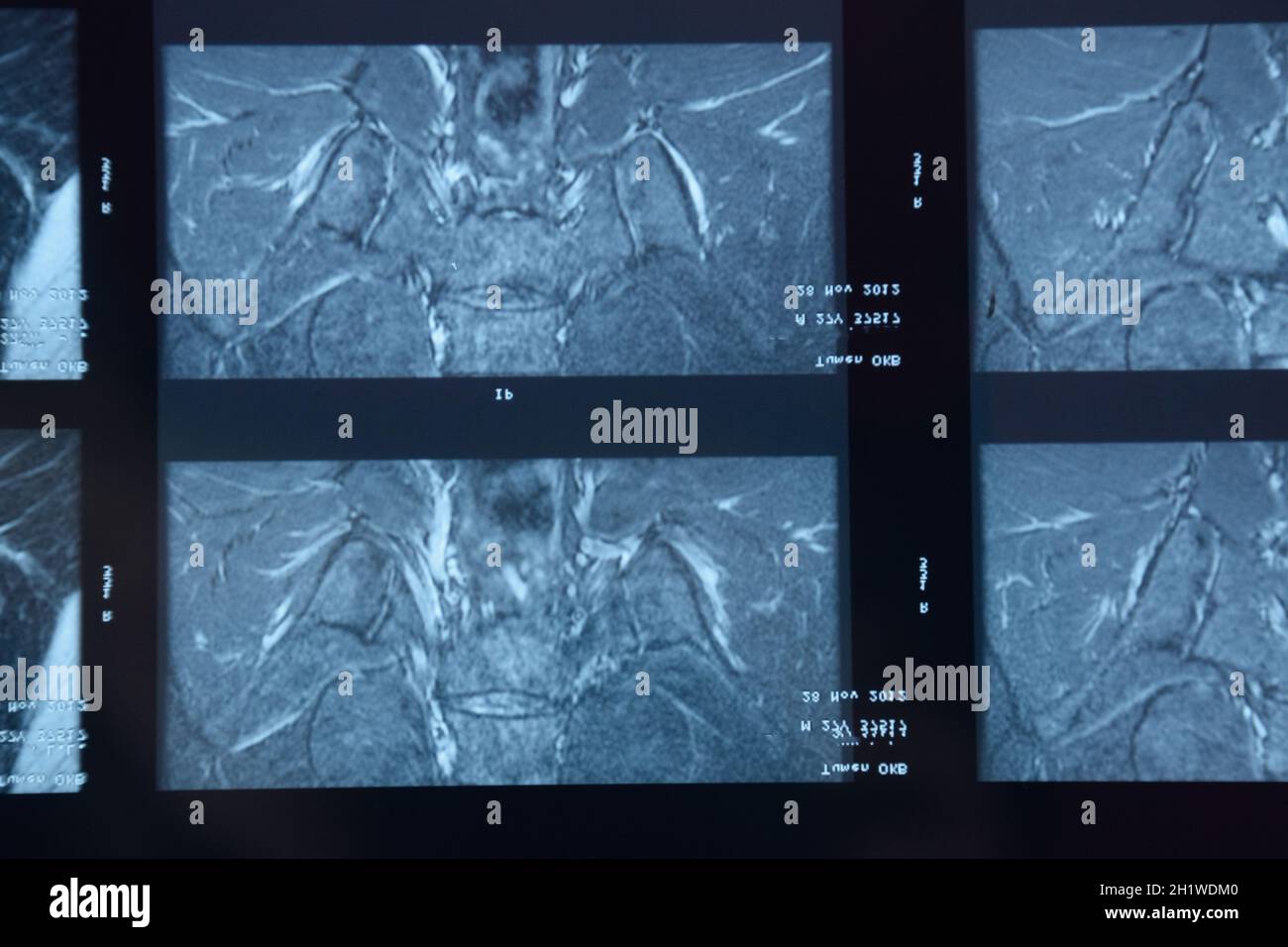 L'IRM de l'articulation sacro-iliaque. Étude de la spondylarthrite spondylarthrite sur patient. Les résultats de l'étude sur la x-ray. Banque D'Images