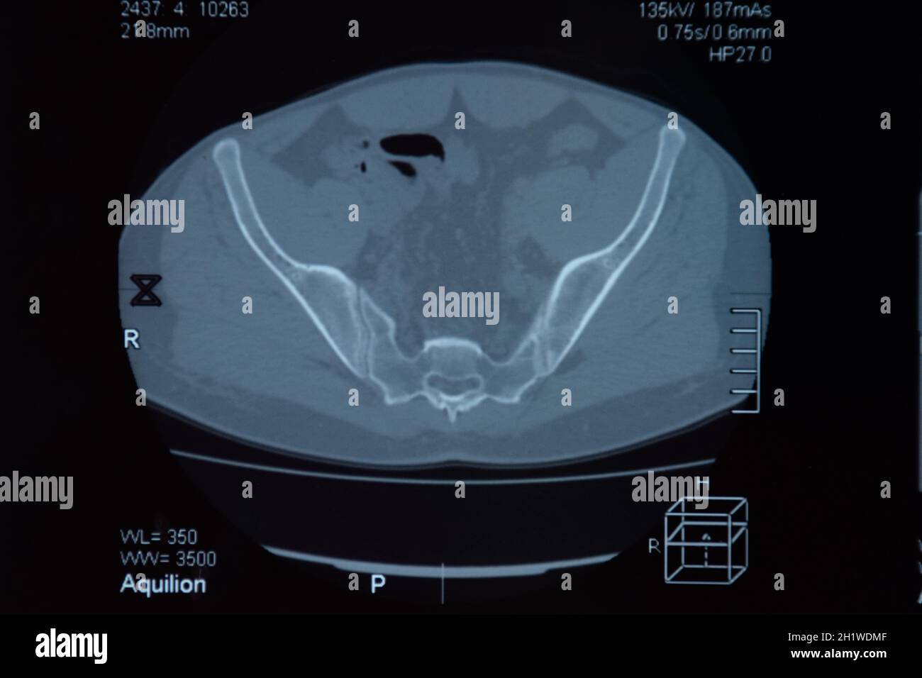 L'IRM de l'articulation sacro-iliaque. Étude de la spondylarthrite spondylarthrite sur patient. Les résultats de l'étude sur la x-ray. Banque D'Images