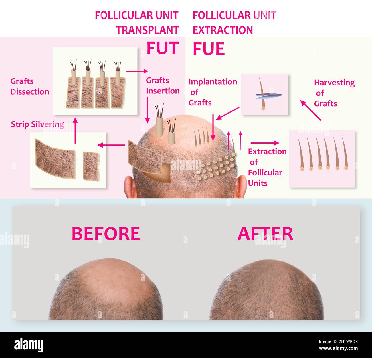 Alopécie humaine ou perte de cheveux - homme adulte main tenant le peigne sur la tête chauve Banque D'Images