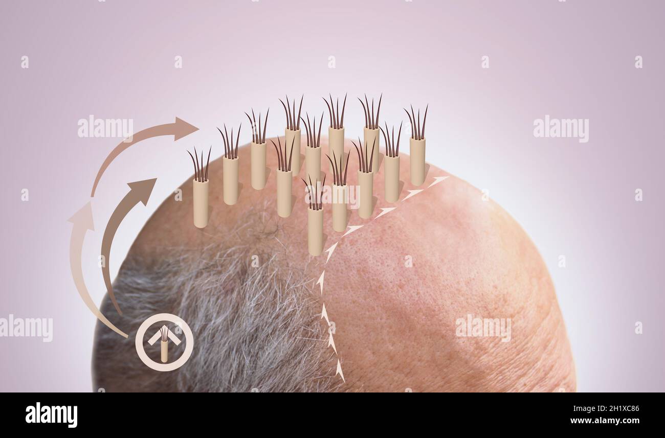 Méthodes de transplantation de cheveux FUT et FUE Fue avec la transplantation comme élément d'illustration. Alopécie humaine ou problème de perte de cheveux sur les adultes Banque D'Images