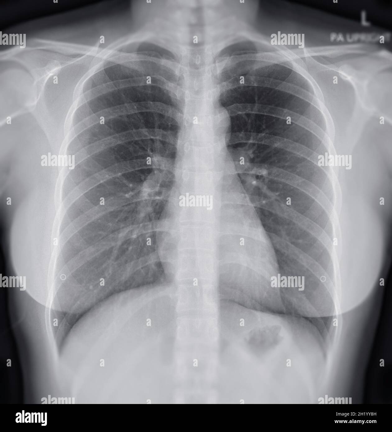Radiographie thoracique du thorax ou du poumon humain montrant un poumon  normal Photo Stock - Alamy