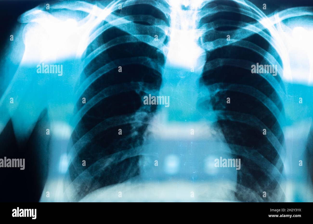 Radiographie pulmonaire, radiographie pulmonaire après une infection par le virus Covid 19 Banque D'Images
