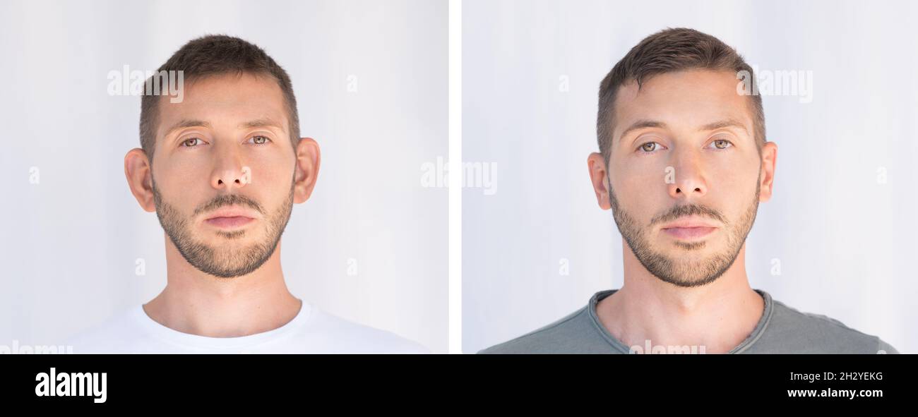Otoplastie.Chirurgie de l'oreille.Avant et après l'opération.Concept de  chirurgie plastique Photo Stock - Alamy