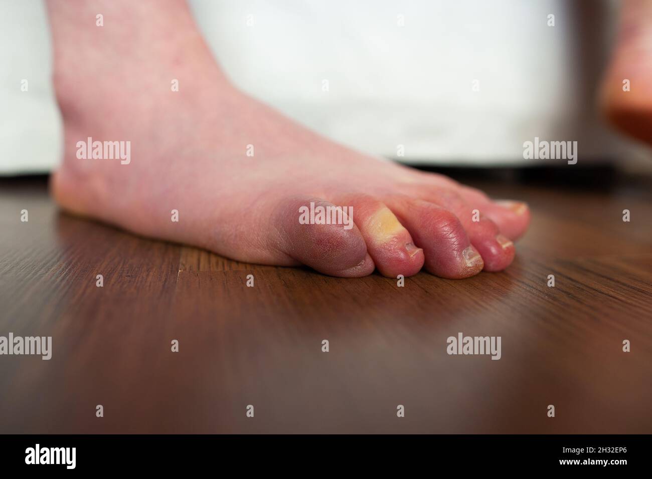 doigts de pieds qui se chevauchent