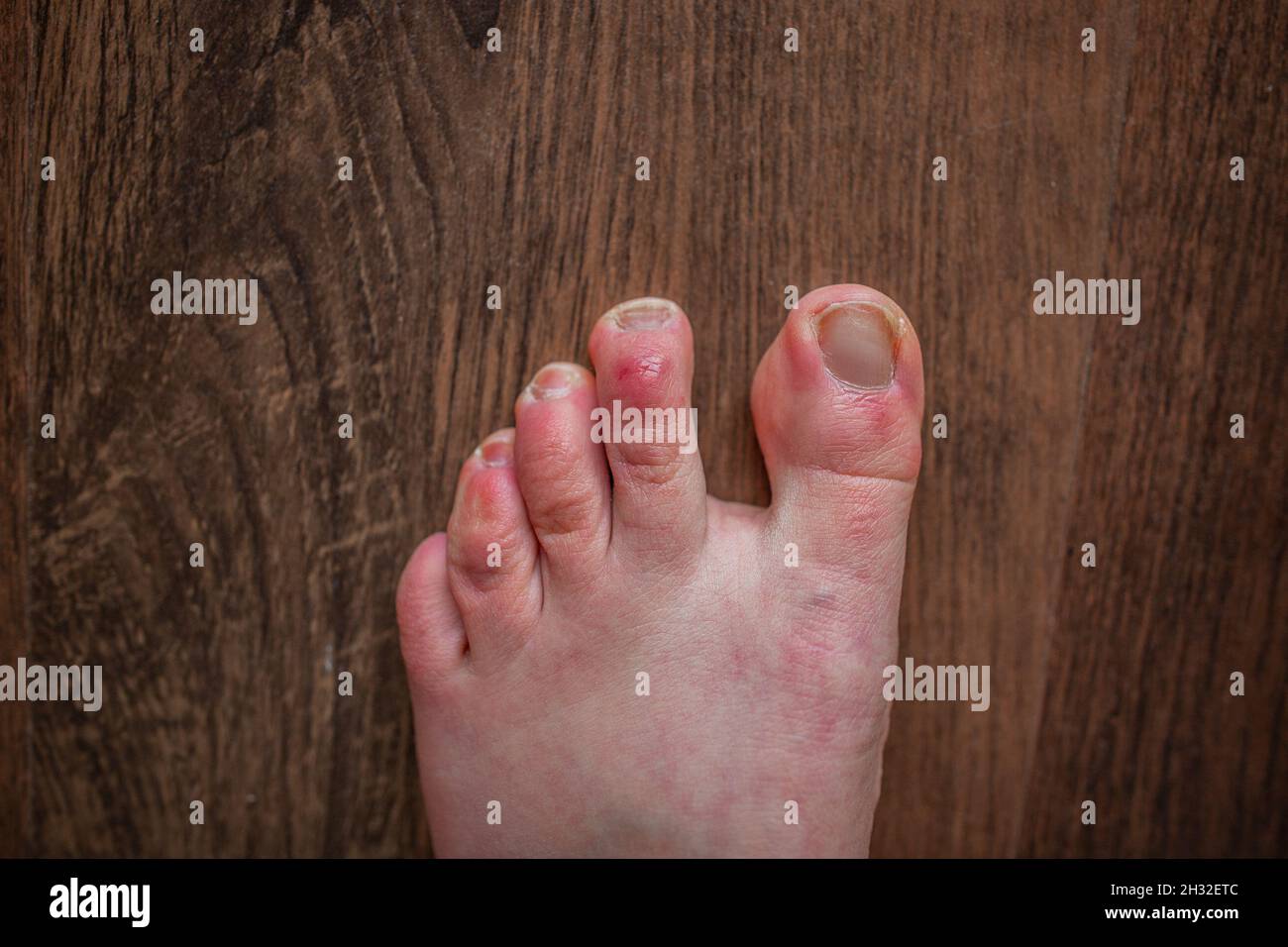 Raynaud syndrome Banque de photographies et d’images à haute résolution Alamy