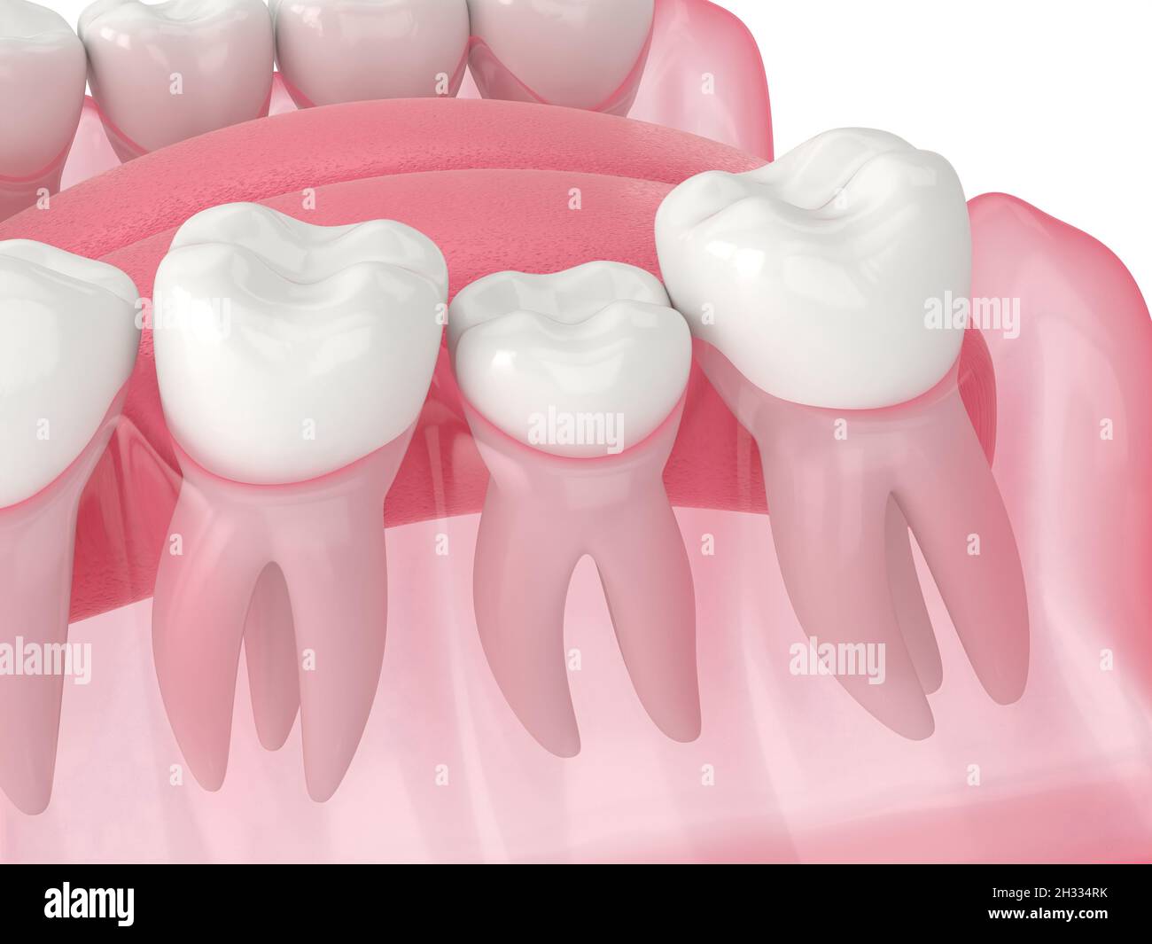 rendu 3d de la croissance des dents bloqué par deux molaires adjacentes.Notion : dents affectées Banque D'Images
