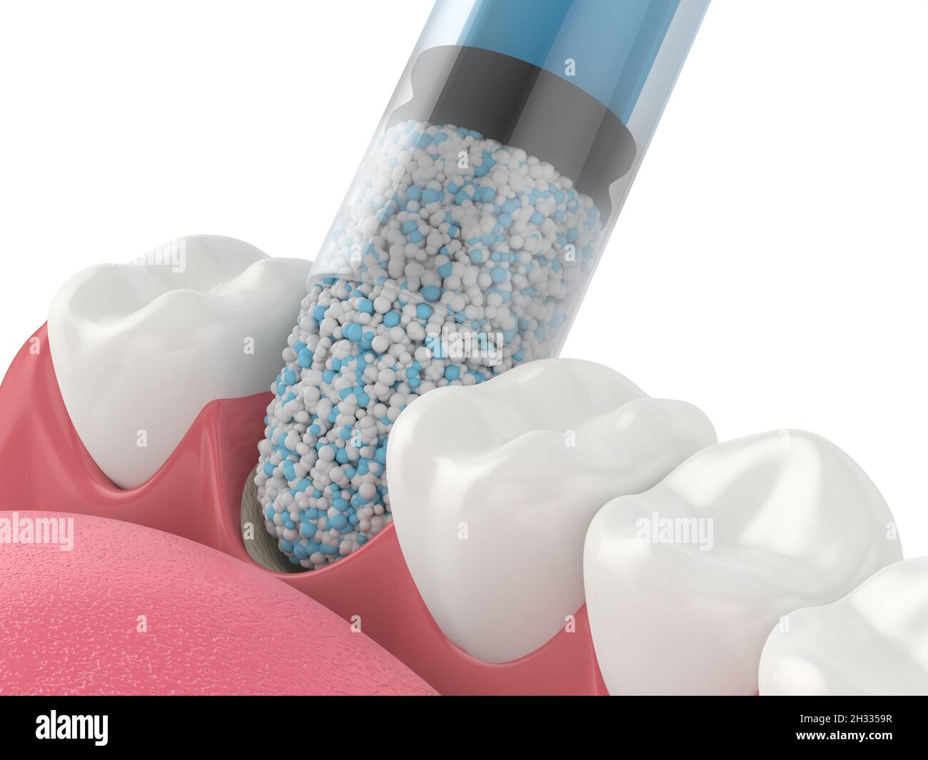 Rendu 3D de la greffe osseuse dentaire avec application biomatérienne osseuse dentaire sur fond blanc.Concept de procédure d'augmentation osseuse de la mâchoire. Banque D'Images