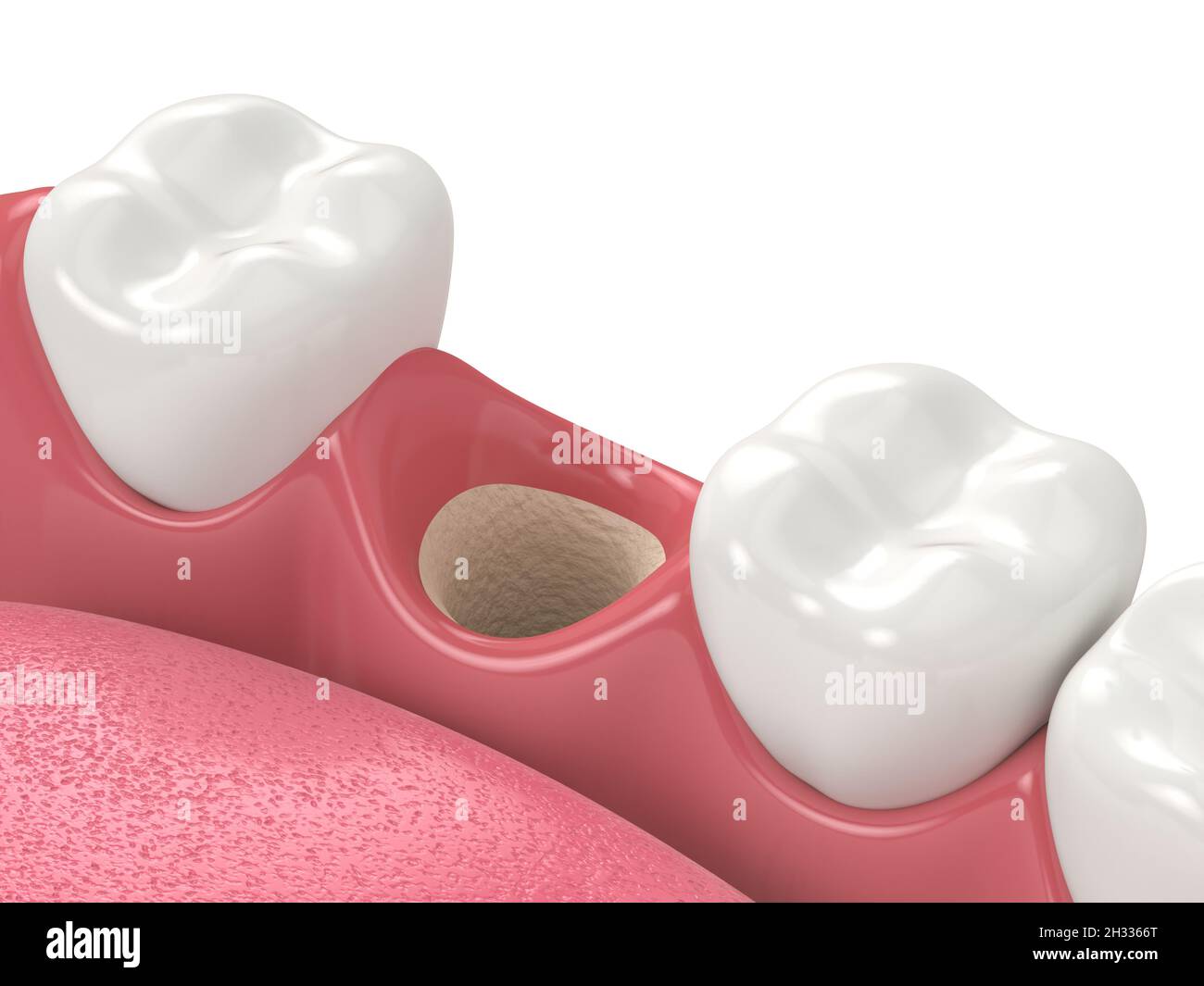 Rendu 3D de la mâchoire avec prise vide prête à la greffe osseuse.Notion : augmentation osseuse de la mâchoire. Banque D'Images