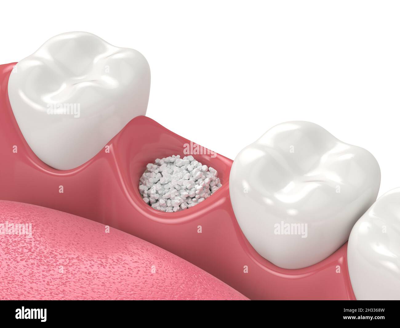 Rendu 3D de la greffe osseuse dentaire avec biomatériau osseux dentaire sur fond blanc.Concept de procédure d'augmentation osseuse de la mâchoire. Banque D'Images