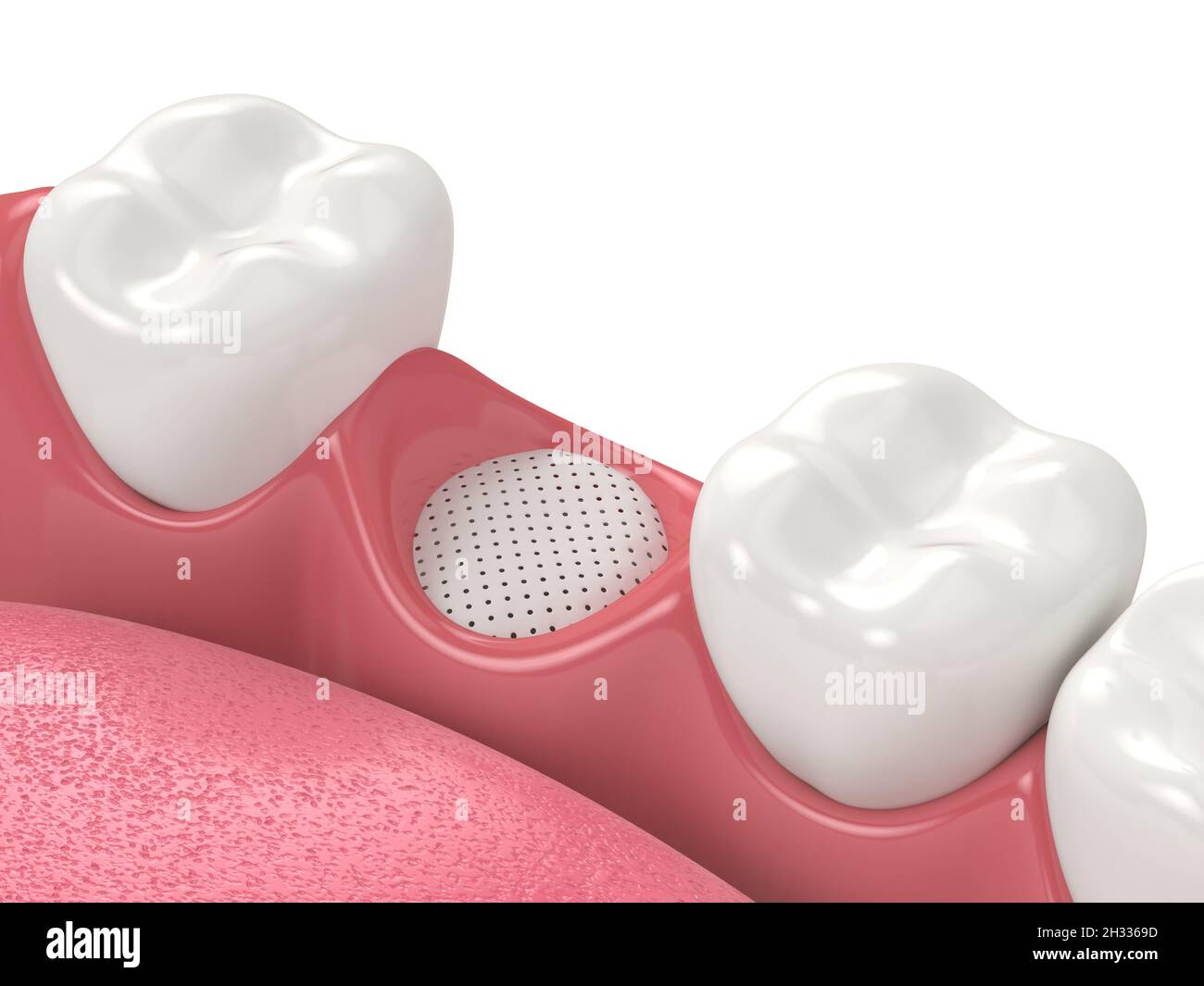Rendu 3D de la greffe osseuse dentaire avec membrane sur fond blanc.Notion : augmentation osseuse de la mâchoire. Banque D'Images