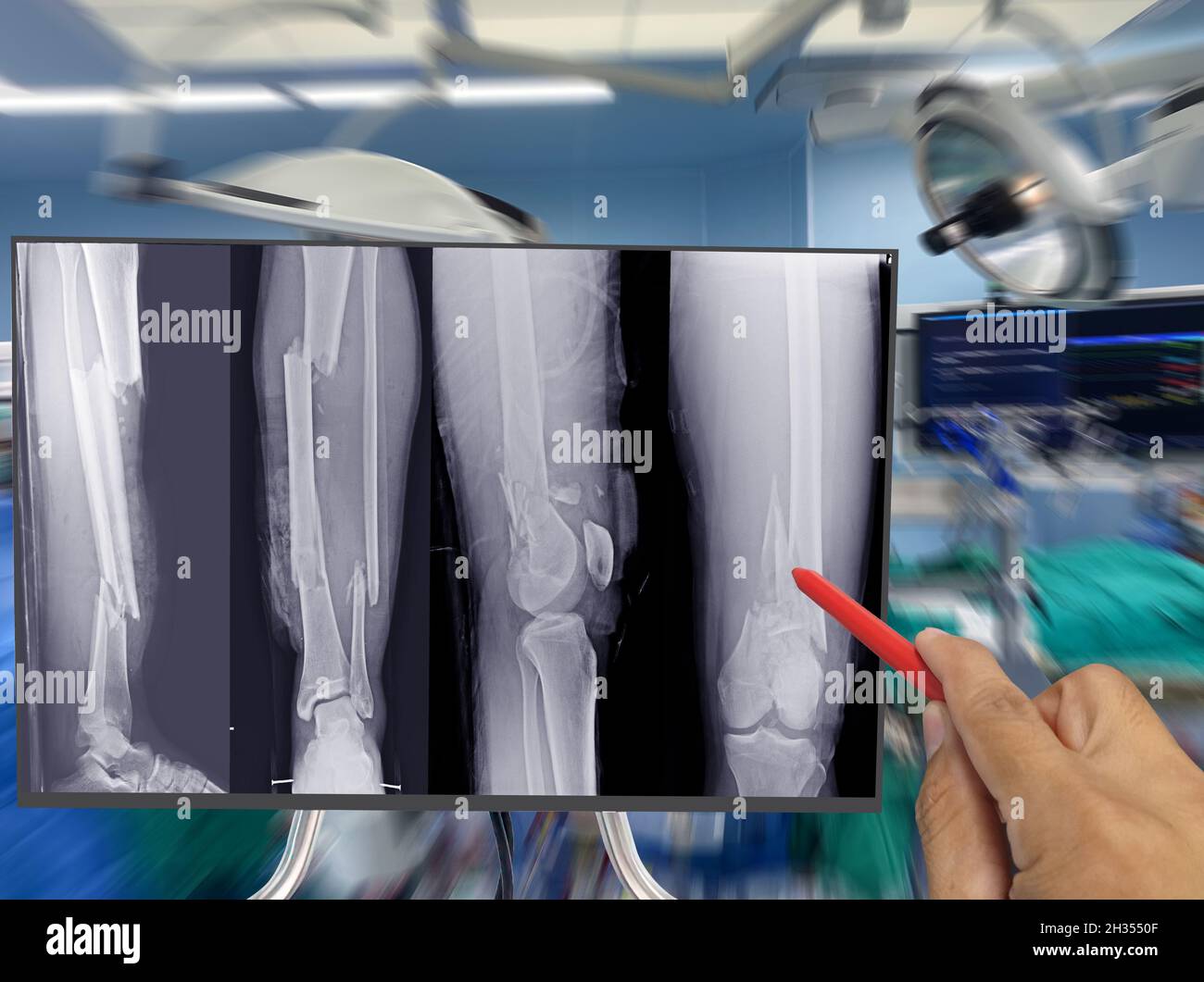 Gros plan X-ray os entier de jambe montrant la fracture multiples fractures osseuses, Docteur tenant un point rouge de plume, symptômes concept de santé médicale. Banque D'Images