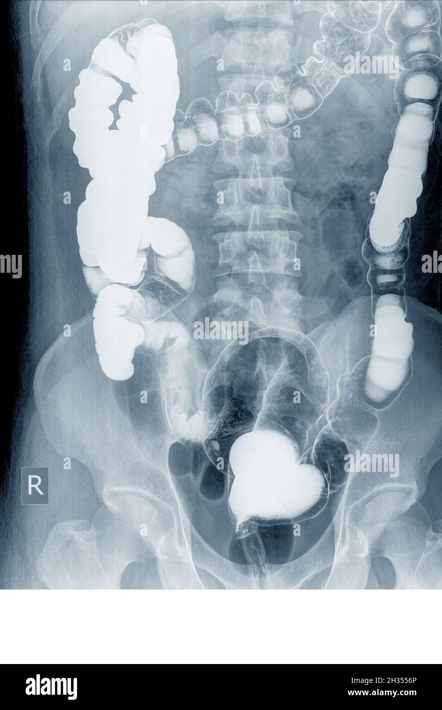 Barium enema x ray Banque de photographies et d’images à haute